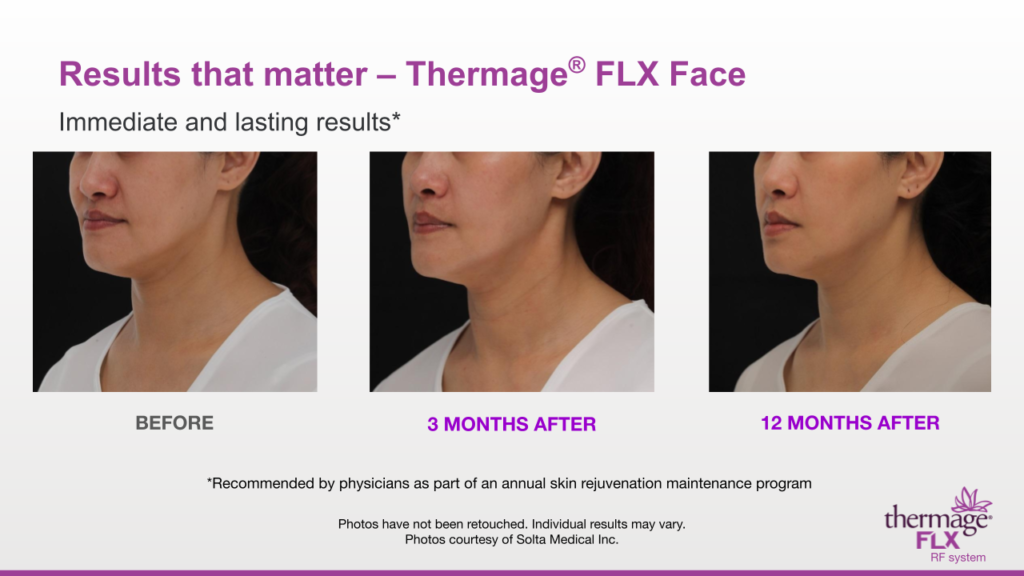 Thermage® Profile Beauty Clinic
